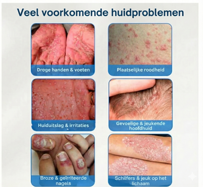 Verum Herba | Crème tegen jeuk, roodheid & irritatie