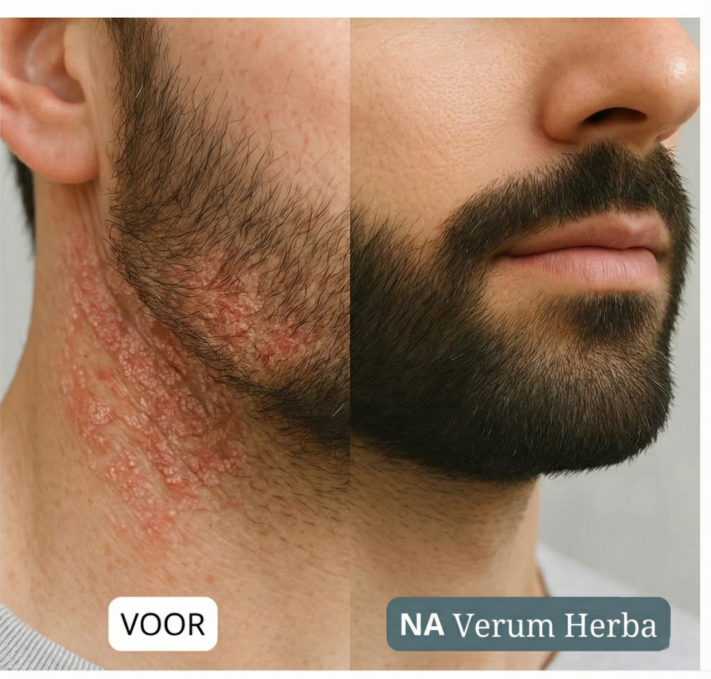 Verum Herba | Crème tegen jeuk, roodheid & irritatie