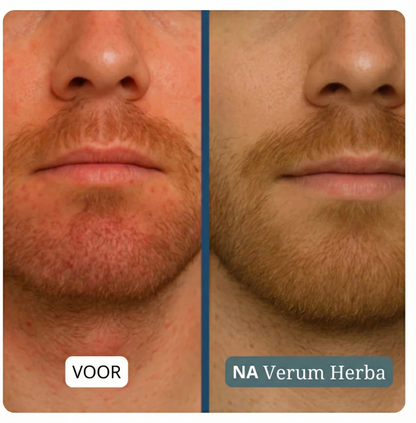 Verum Herba | Crème tegen jeuk, roodheid & irritatie